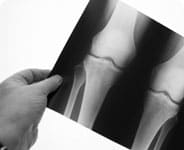 Zimmer next generation knee