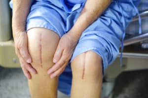 knee replacement scars