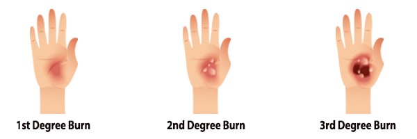 Types of burn injuries caused by accidental pressure cooker explosions