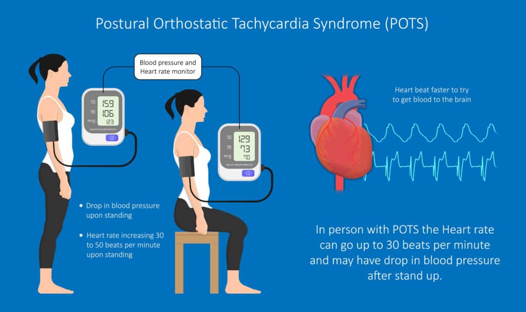 Diagram of blood pressure and heart rate changes from POTS