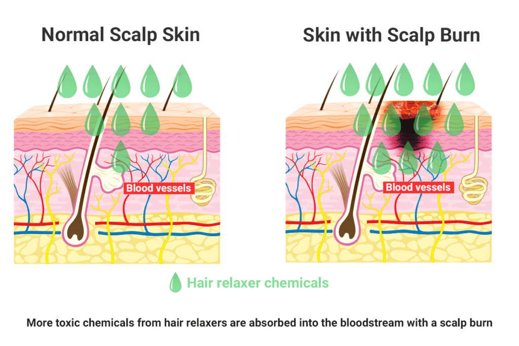 Scalp Burn from hair relaxer increases cancer risk diagram