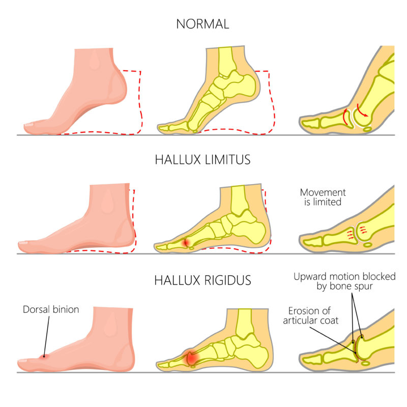 Cartiva implants for Hallux Limitus and Hallux Rigidus