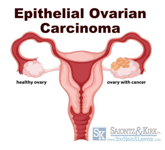 Epithelial Ovarian Cancer From Hair Relaxer