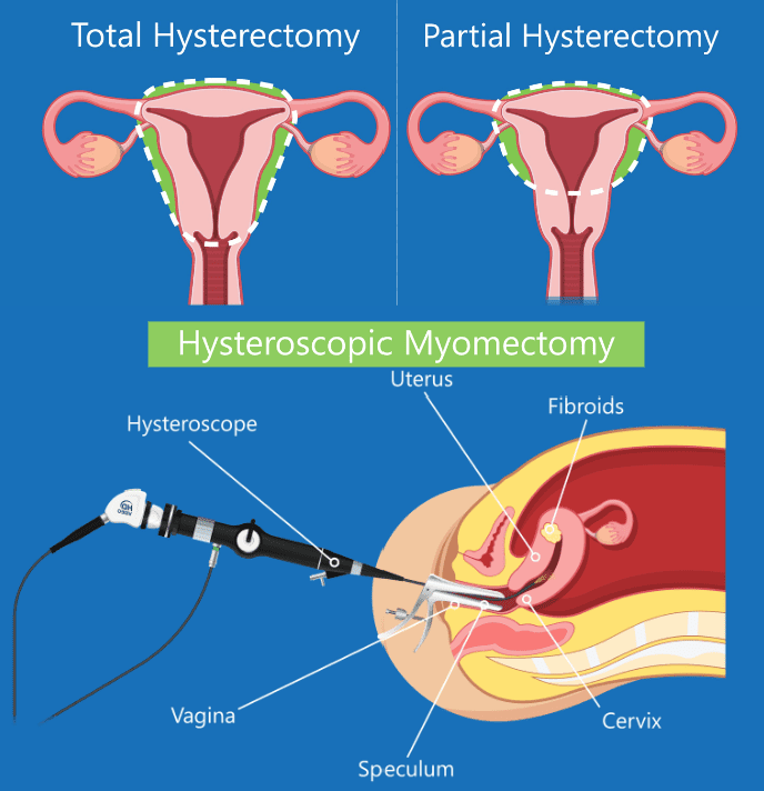 What is the surgery to remove uterine fibroids? A full hysterectomy, partial hysterectomy or myomectomy are the most common surgery to remove uterine fibroids.