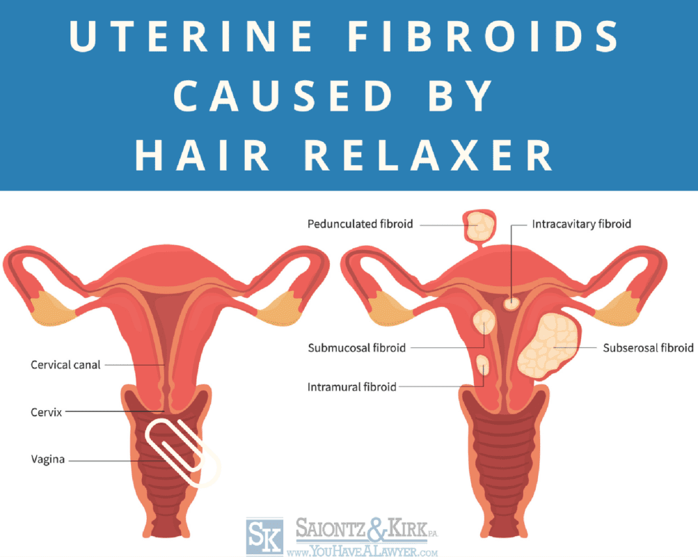What type of uterine fibroids do hair relaxers cause?