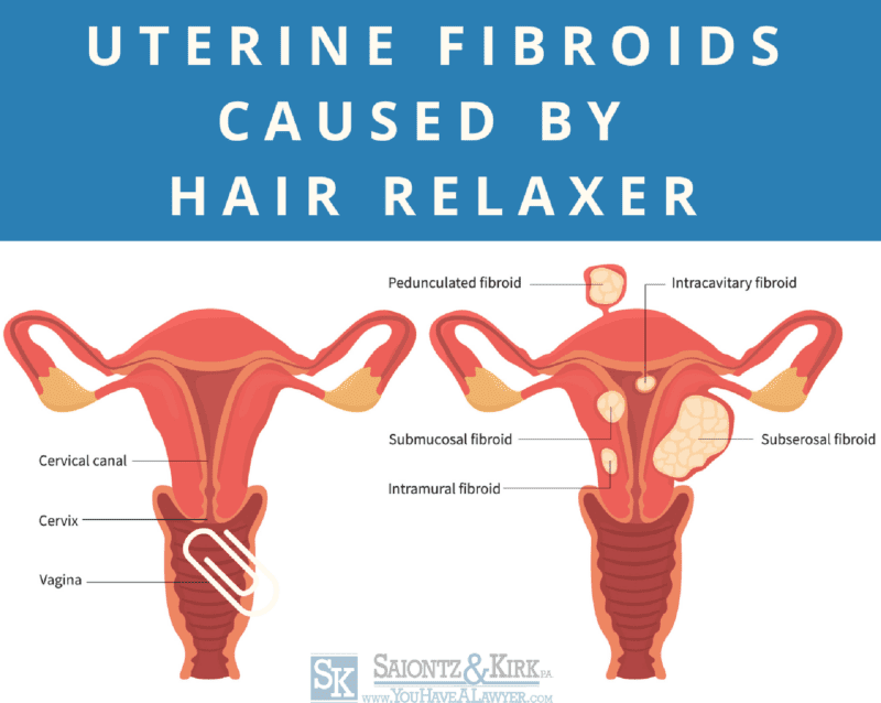 Hair Relaxer Uterine Fibroids Lawsuit - Saiontz & Kirk - YouHaveALawyer.com
