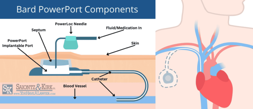 Bard PowerPort Components