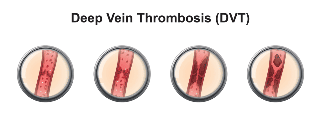 Bard PowerPort Deep Vein Thrombosis (DVT)