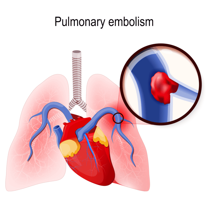 Bard PowerPort Pulmonary Embolism
