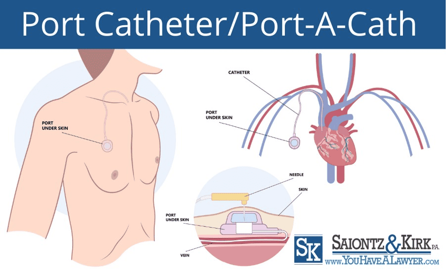 What is a port a catheter