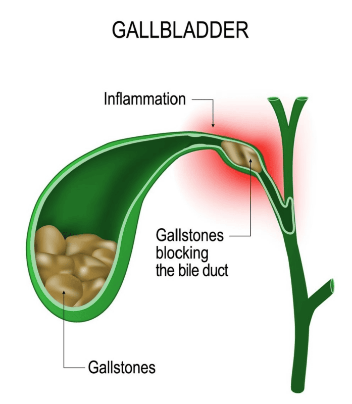 Gallbladder problems from Ozempic