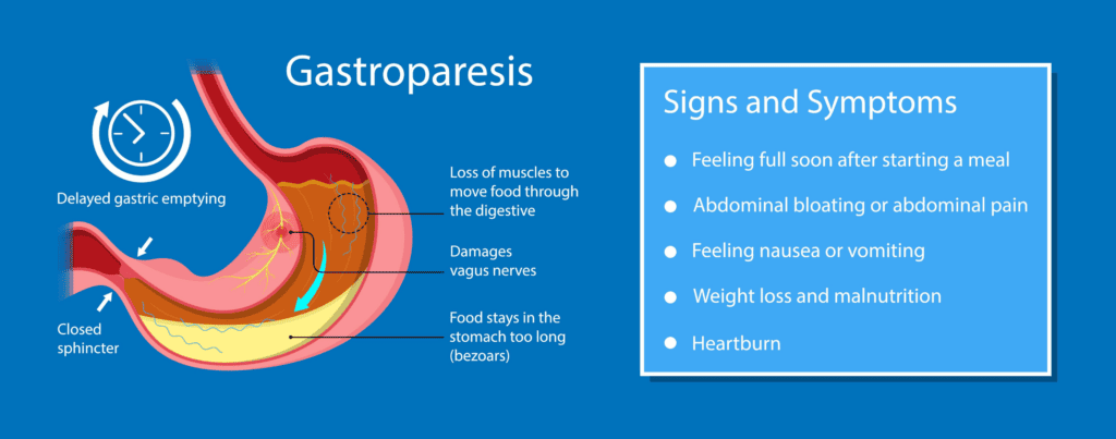 Ozempic Gastroparesis Signs and Symptoms