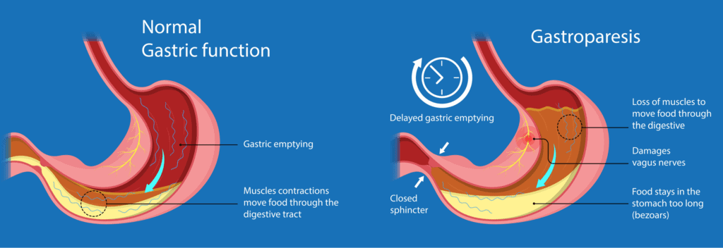 What is gastroparesis?