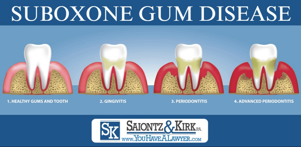 Suboxone Gum Disease Side Effects