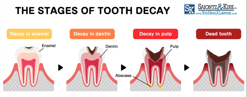 Suboxone Tooth Decay Stages