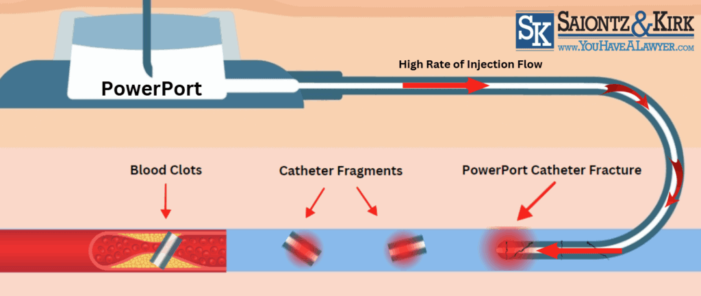 Bard-PowerPort-Fracture
