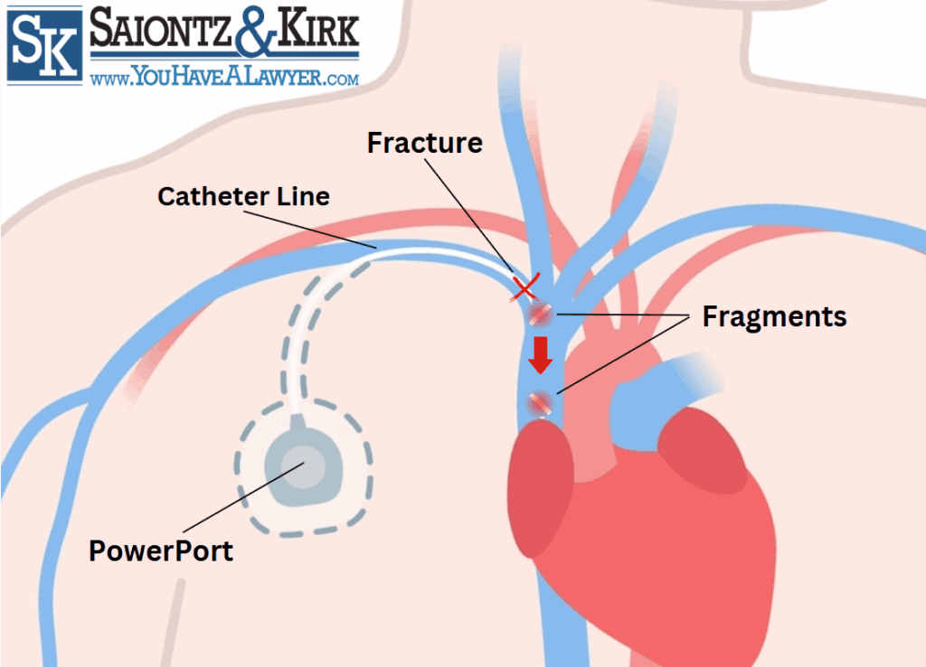 Bard PowerPort Chemo Port Fracture Lawsuit