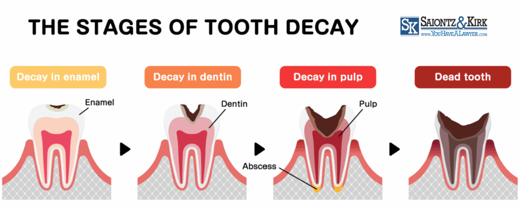 Stages of Suboxone Tooth Decay